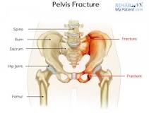 Image result for broken pelvis recovery time