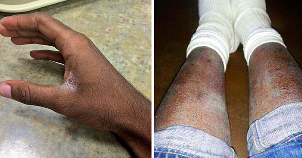 african_american_dry_skin.jpg