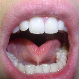 tongue-tie-treatment-raleigh-north-carolina.jpg